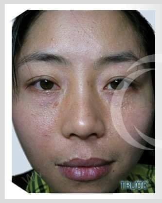 KEM XÓA MỤN THỊT - BỌNG MẮT - QUẦNG THÂM MẮT