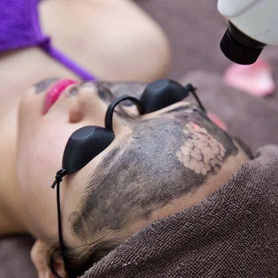 Than hoạt tính Laser Carbon peel cream
