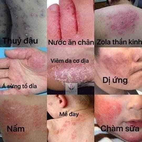 [HCM]Kem bôi da Thảo Mộc Nam
