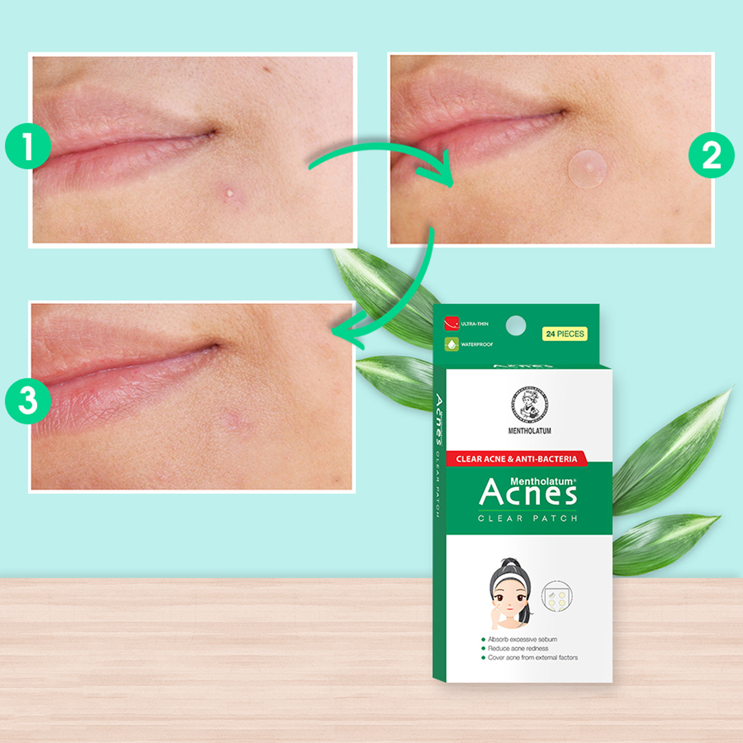 Miếng Dán Mụn Acnes Clear Patch 24 Miếng Hasaki Sản phẩm chính hãng