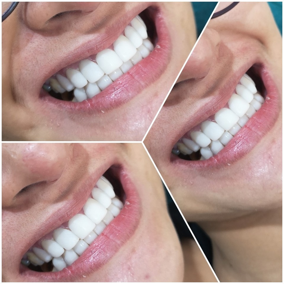 đèn chiếu đính đá răng+phủ răng sứ 99s ánh sáng mạnh x5