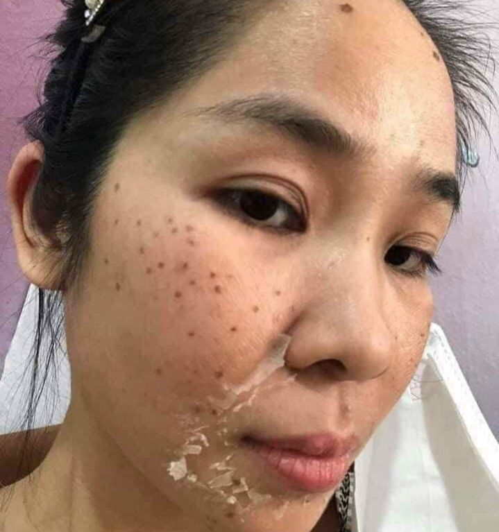 [Genuine] Yody Phuong Anh Skin Peeling Treatment Helps Even Skin Tone