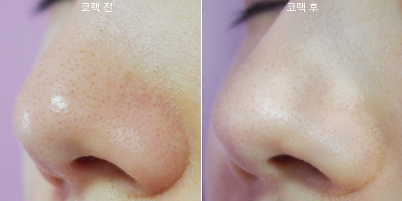 Mặt Nạ Lột Mụn Cám, Đầu Đen Queen 50g