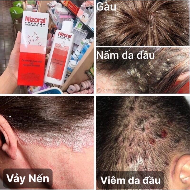 Dầu gội giảm gàu Thái Lan chai 100ml