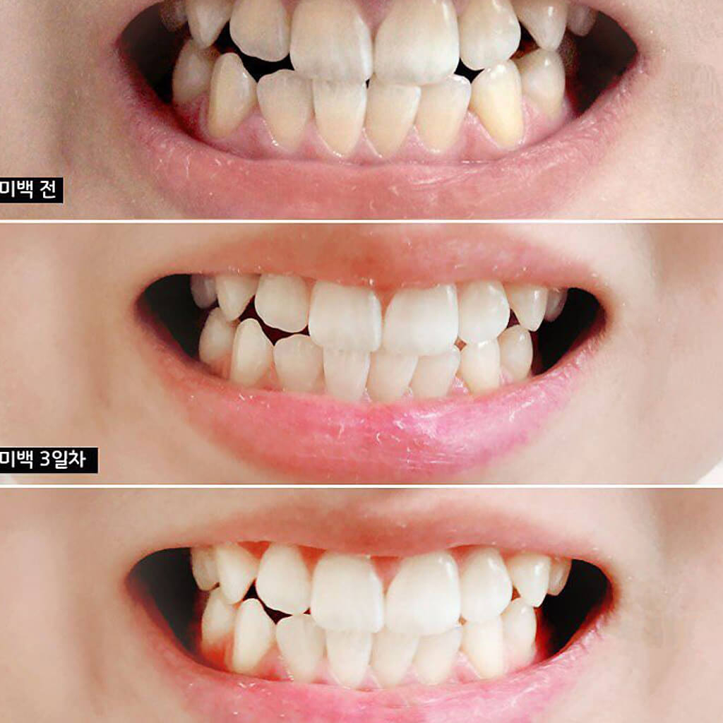 Kem Đánh Trắng Răng Median Dental