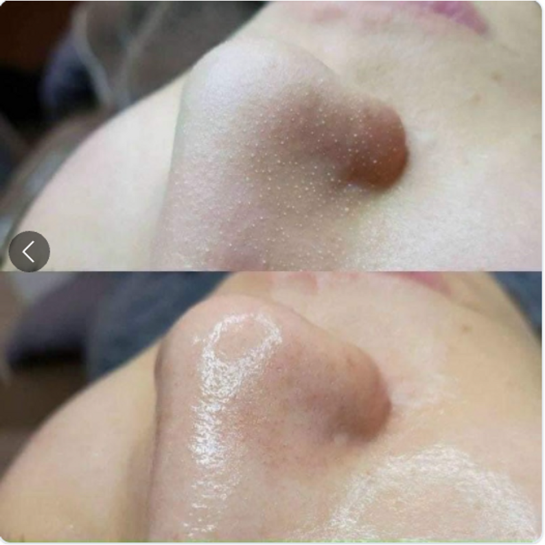 Ủ mụn đầu đen Remove BlackHeads - PHUONGANHOUSE