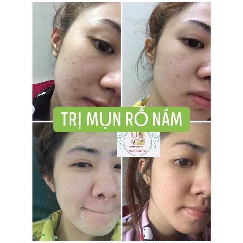 THẢO DƯỢC MT SẠCH MỤN THÂM RỖ TRIỆT ĐỂ (50ML)