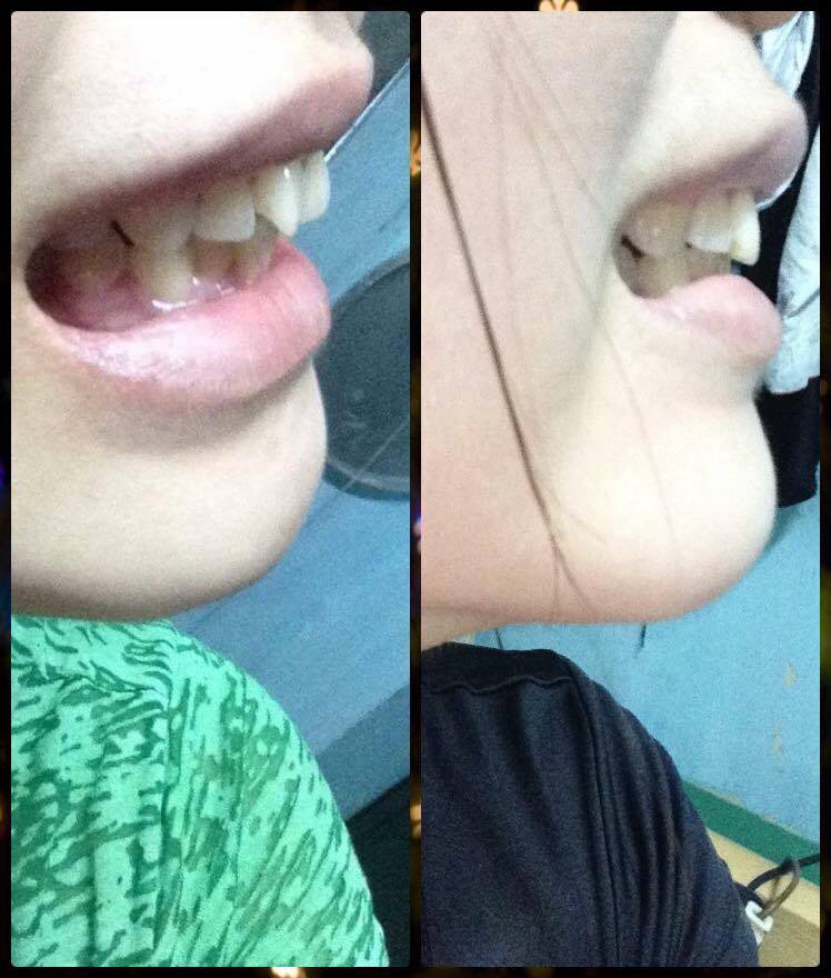 [HCM][COMBO]DỤNG CỤ NIỀNG RĂNG NGƯỜI LỚN [A1 + A2 +A3]