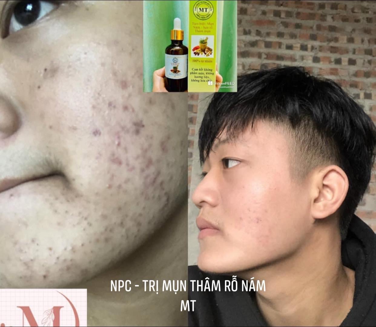 Thảo dược sạch mụn thâm rỗ không tái lại (50ML)