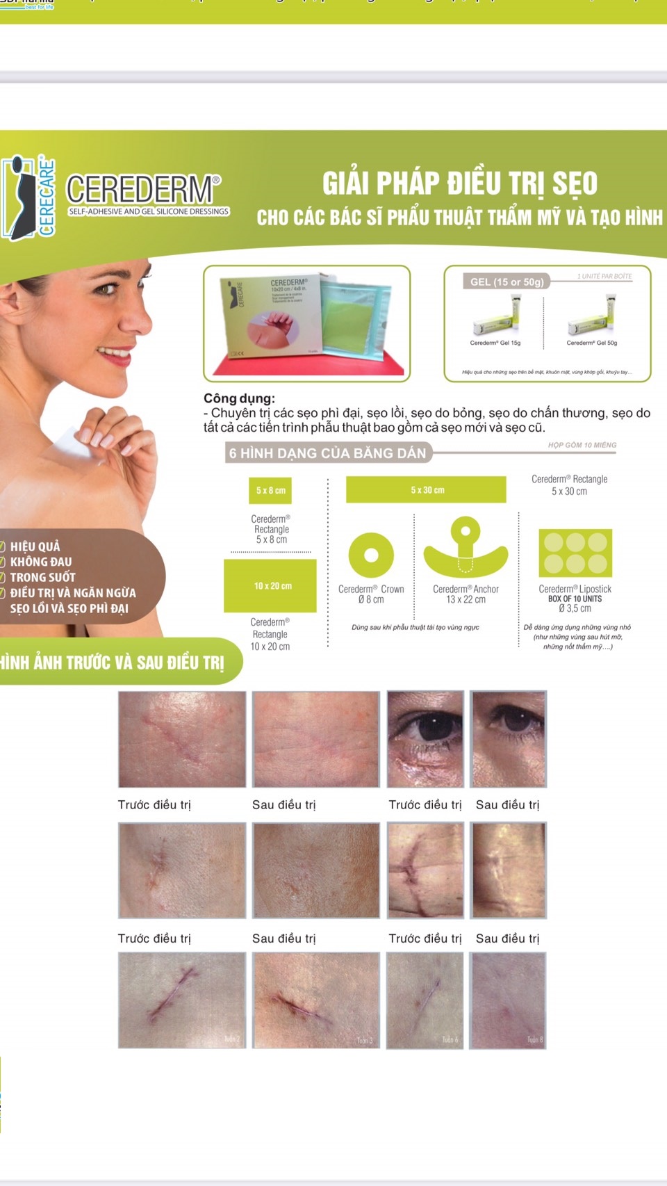 Miếng dán sẹo Cerederm phẫu thuật sau hút mỡ 10*20cm