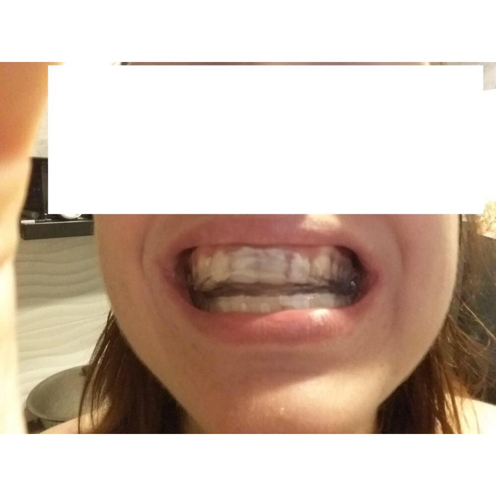 Máng tẩy trắng răng tại nhà