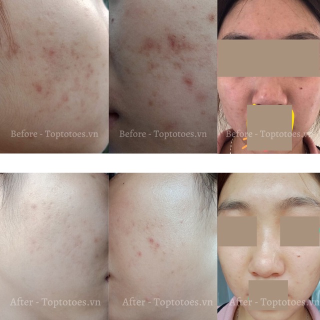 Serum Teana ASAP super peptides thâm mụn, mờ đồi mồi