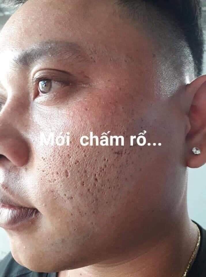 CHẤM TÀN NHANG MỤN NÁM RỖ PHƯƠNG ANH