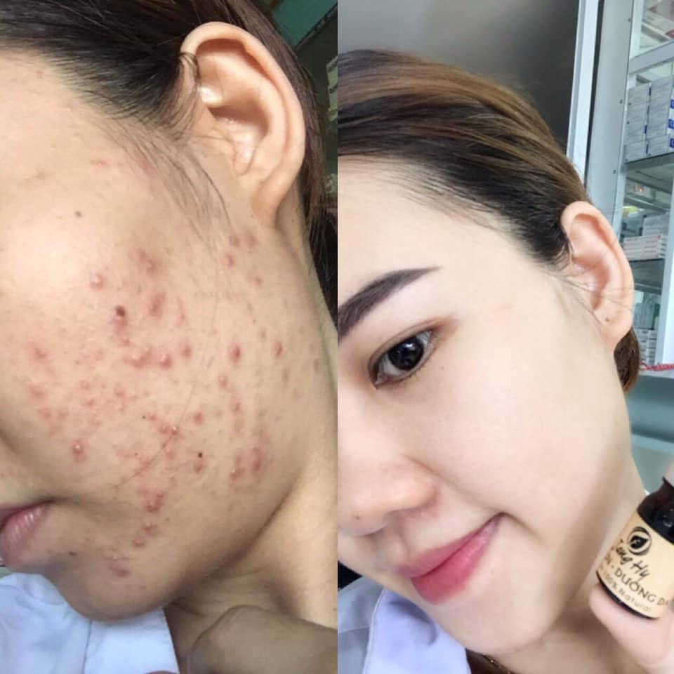 [HCM]Trị mụn Jang Hy