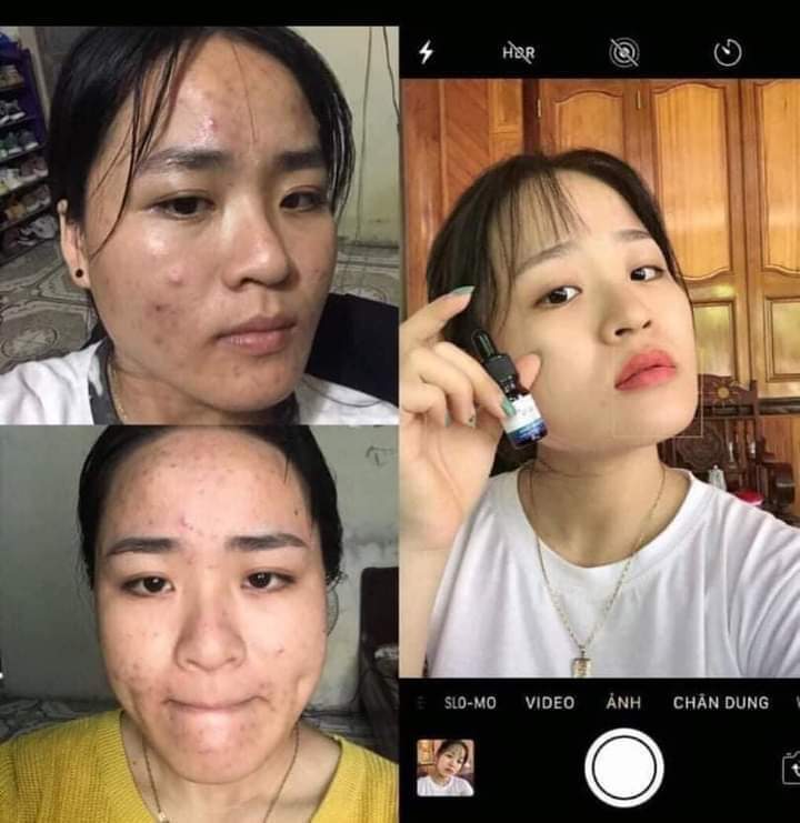 SERUM TRỊ MỤN NEWSKIN - SIÊU TRỊ MỤN 3IN1