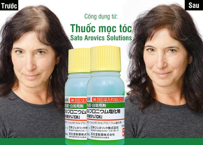 Serum Mọc Tóc Sato Nhật Bản Tinh Chất Mọc Tóc Sato Nhật Bản 30ml