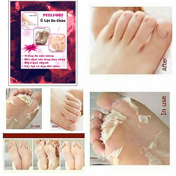 [HCM]Feelfoot Ủ Lột Da Chân Trắng Da Hết Chai Sần