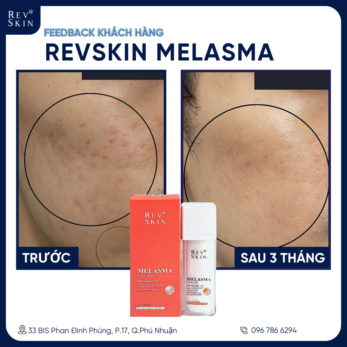 Kem Làm Mờ Thâm, Nám - RevSkin Melasma Cream