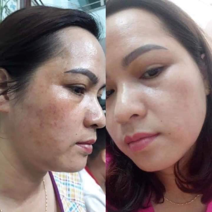 kem nám tàn nhang trắng da sâm nhung elbon