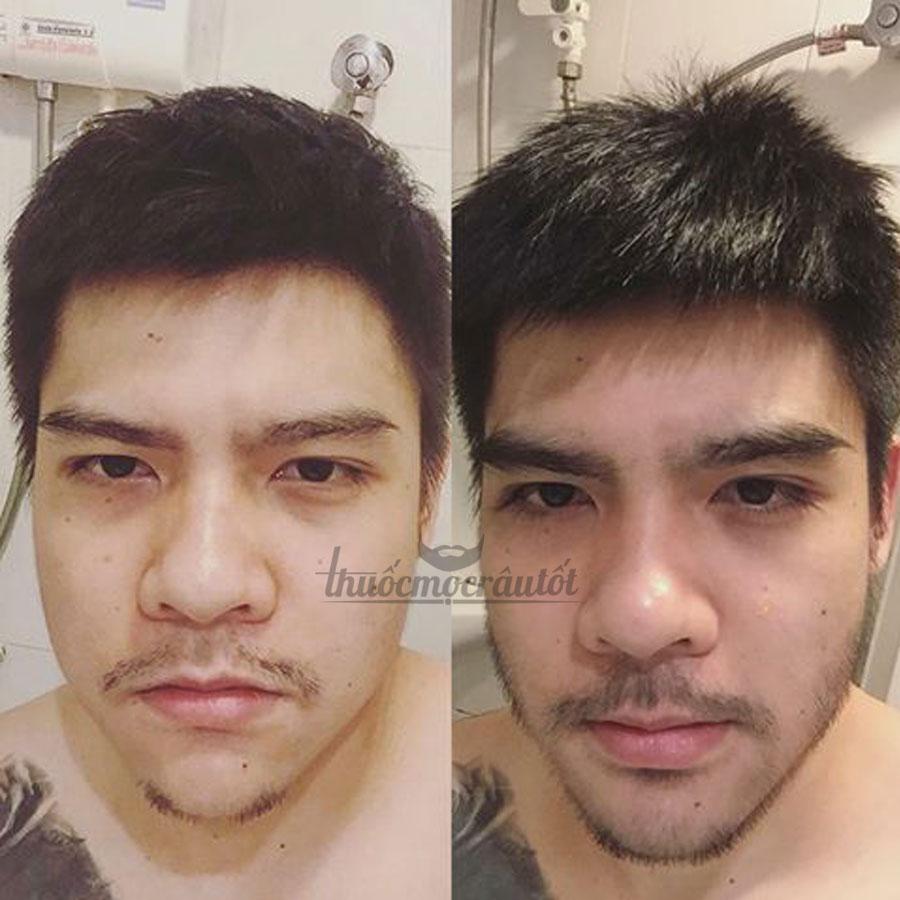[HCM]Minoxidil 5% mọc Râu Tóc Mỹ hãng Kirkland tặng bột LCLT