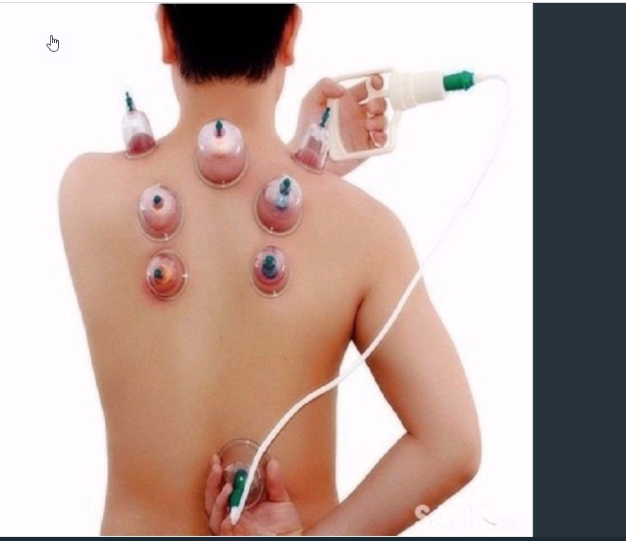 Bộ Giác Hơi Không Dùng Lửa - Bộ Giác Hơi Không Dùng Lửa