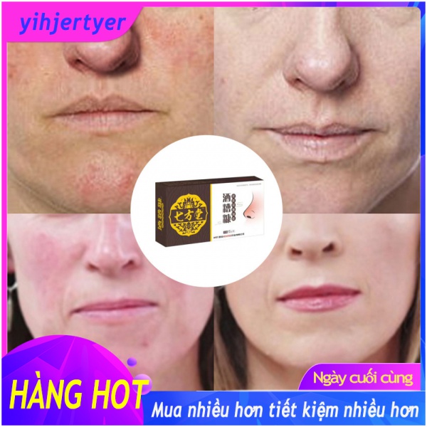Herbal anti lapel acne red rosacea acne treatment blackhead removal acne shrink pore face removal ointment