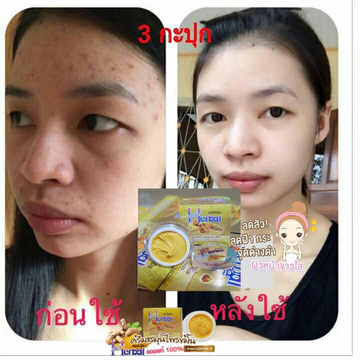 Kem nghệ Herbal Thái Lan trắng da giảm mụn chống thâm