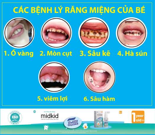 Xịt chống sâu răng MIDKID 30ml bảo vệ răng miệng cho bé