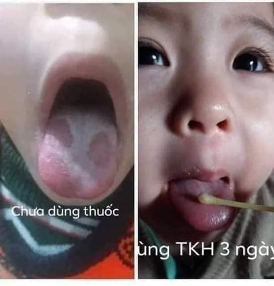 SÂU RĂNG,HÔI MIỆNG,CHẢY MÁU CHÂN RĂNG