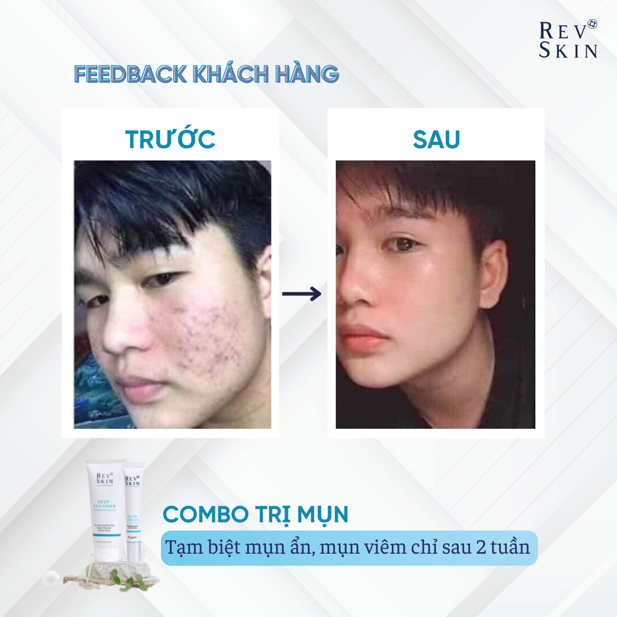 Kem Chấm Mụn RevSkin Acne Cream - 10g