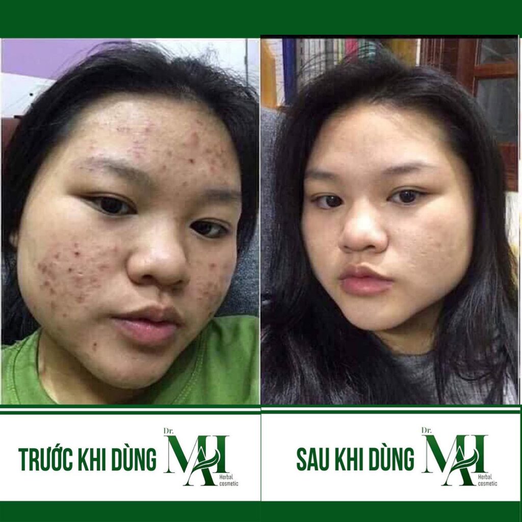 (Chính hãng), Dr Mai, Sạch mụn hiệu quả, Tri Mun, Tri Thâm