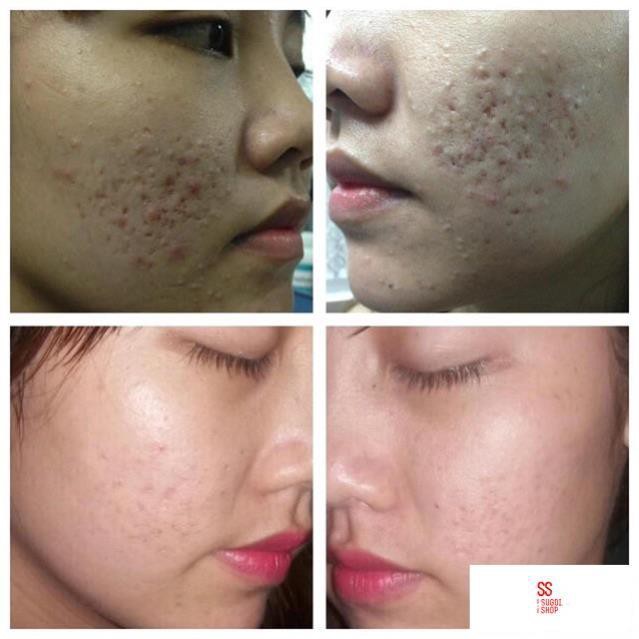 Kem giảm mụn Pair Nhật Bản - kem mụn pair 24g
