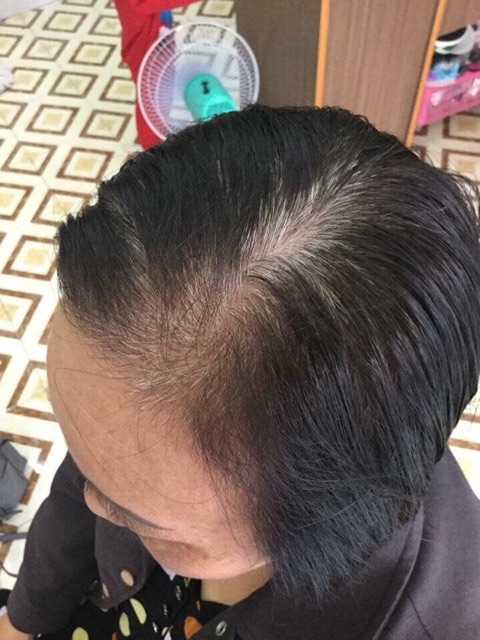 Tóc Giả Mái Dài Che Hói