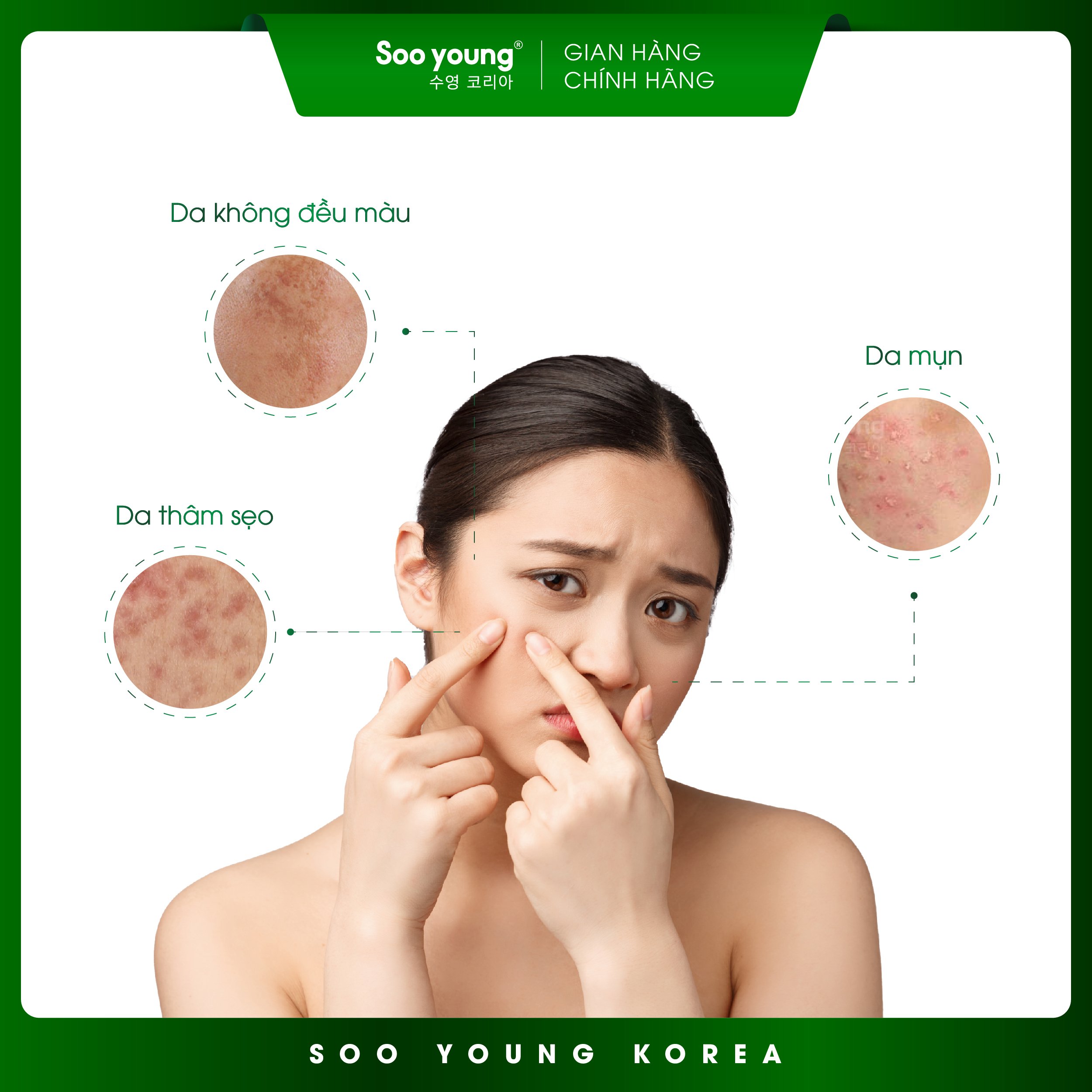 Combo mụn Soo Young