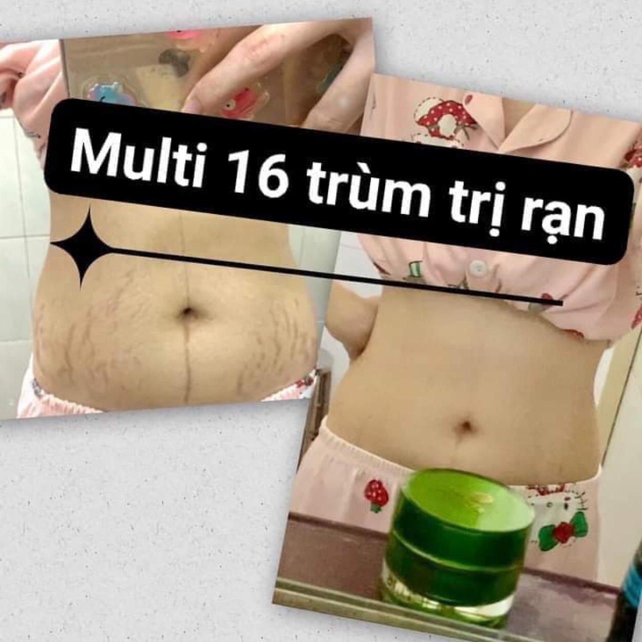 [100% CHÍNH HÃNG ] Kem Rạn Da Multi 16 - Làm Mờ Rạn Da Sau Sinh Và Rạn Da Do Tăng Cân (20g)