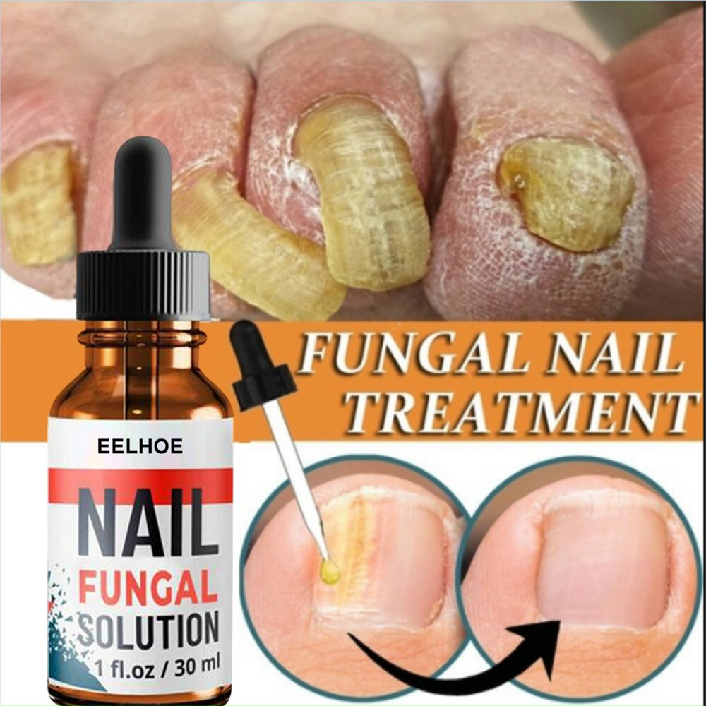 Serum trị nấm móng dưỡng móng phục hồi móng hư tổn
