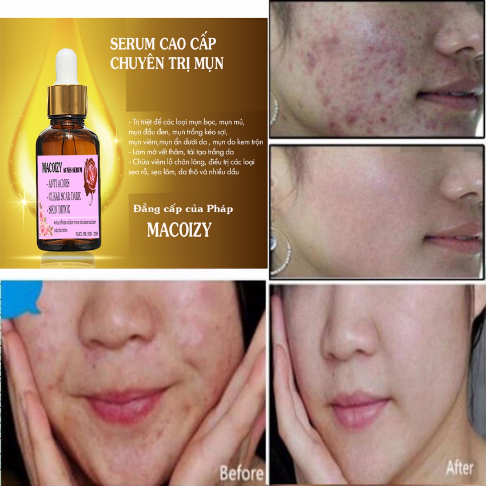 [HCM]Serum Giảm Mụn Mờ Thâm Macoizy Của Pháp
