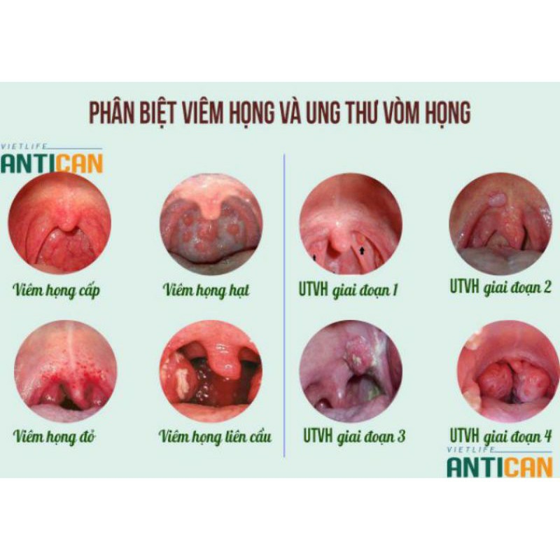 Ông cụ làng nghè - Ho, viêm amidan, viêm họng hạt