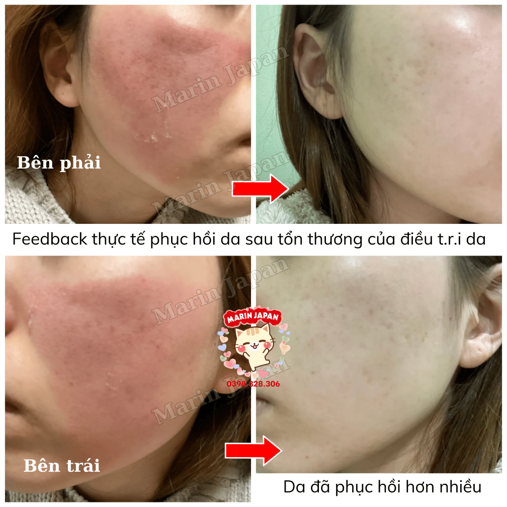(Hàng Nhật,có bill store) kem thâm sẹo, thâm mụn Smoothe Nhật Bản