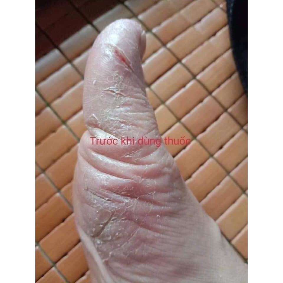 Kem Bôi Nấm Ngứa, Á Sừng