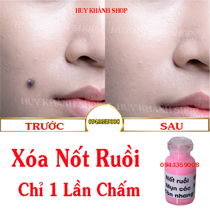 XOA NOT RUOI, TAN NHANG , MUN COC, MUN THIT