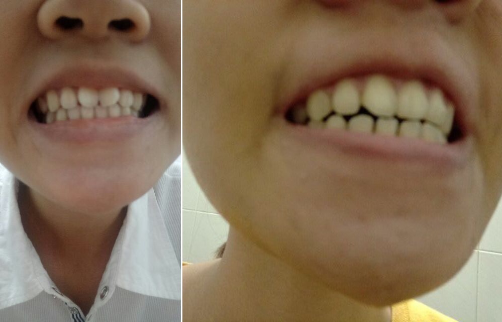 Bộ Niềng Răng Tại Nhà - Orthodontic Alignment Trainer Kit