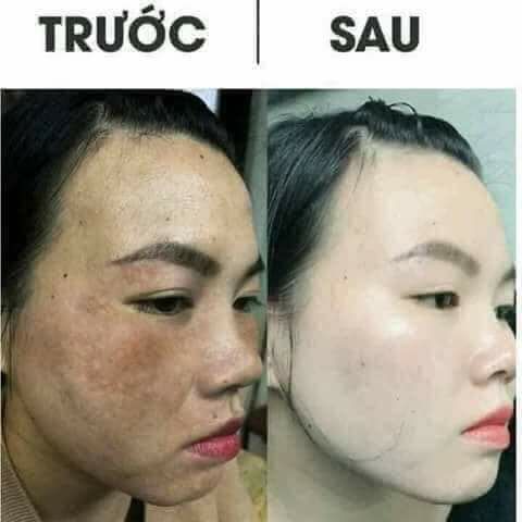 <HCM>Kem mụn trắng da ngừa nám BN WHITE