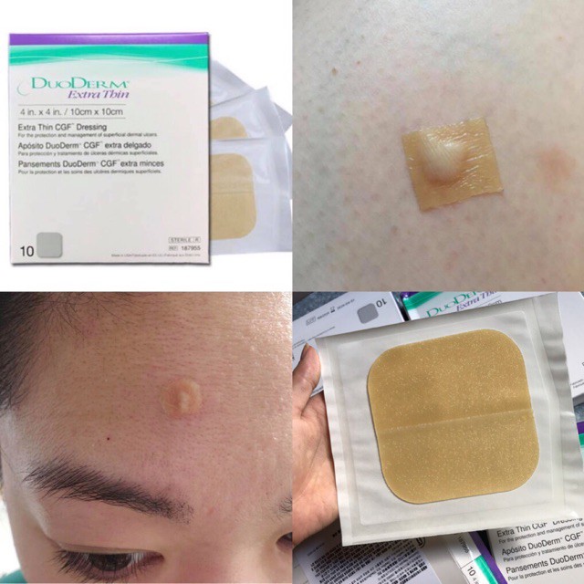 Miếng Dán Mụn Duoderm Extra Thin