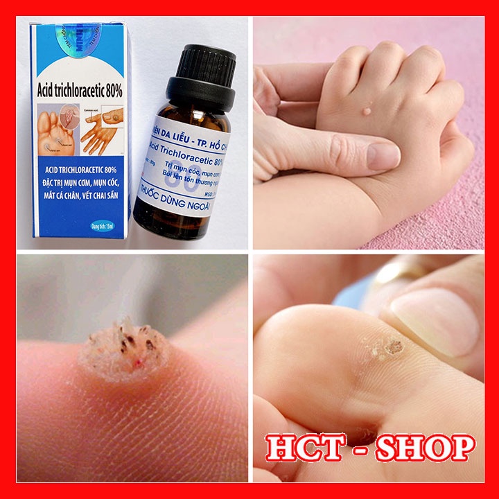 Mụn Cơm Mụn Cóc Mắt Cá Chân Vết Chai Sần