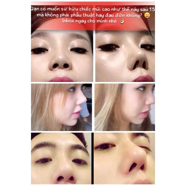 [HCM]Sụn nâng mũi 3D Hàn Quốc