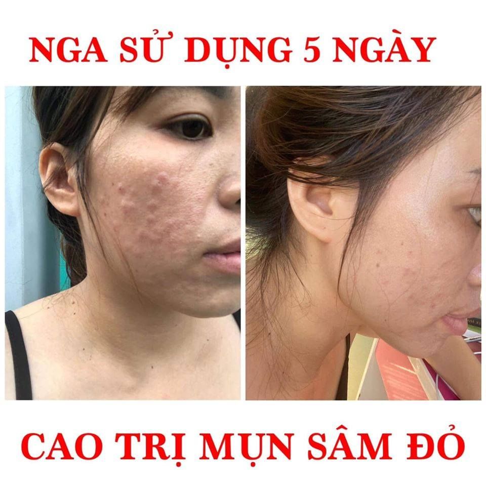 [HCM]Cao m ụn sâm đỏ 15g - Cao sâm đỏ - Cao tri. mun - Kem tri. mun