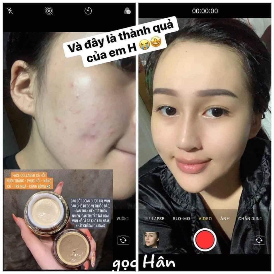 (CAO MỤN SÂM ĐỎ- CHẤM DỨT MỤN SAU 14 NGÀY FULL 15GR