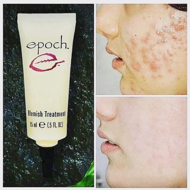 [HCM]Tý chấm Mụn Epoch của Nuskin