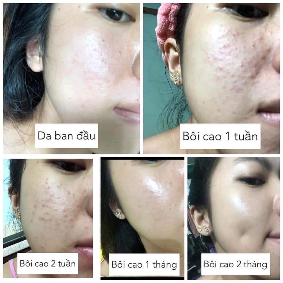 Combo Cao Mụn Sâm Đỏ + Sữa rửa mặt Nhân Sâm - sạch mụn sáng da